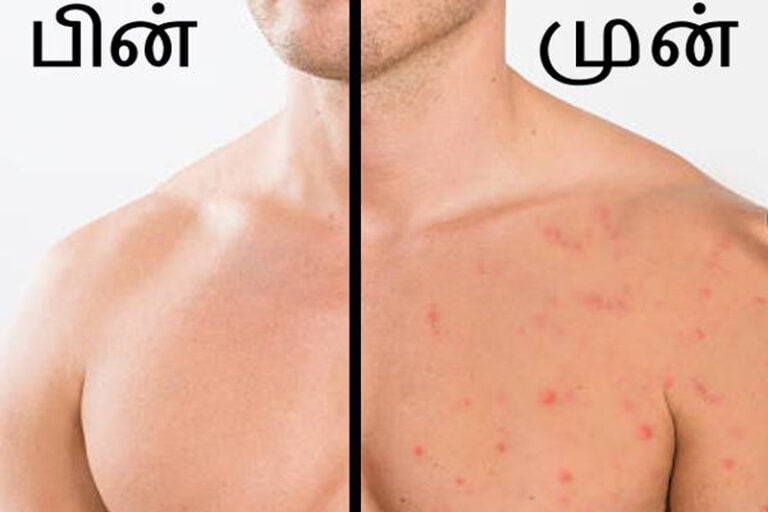 grooming Thedalweb grooming guide for men to get rid of chest acne in Tamil - ஆண்களின் மார்பு பகுதியில் வரும் வலிமிக்க பருக்களைப் போக்கும் எளிய வழிகள்!