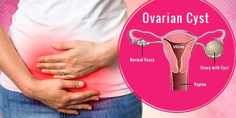 ovarian cyst Thedalweb கருப்பை நீர்க்கட்டி கரைய பாட்டி வைத்தியம்! (Uterine Cyst Dissolution)