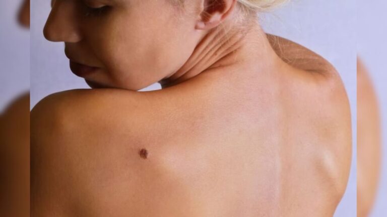 இந்த இடங்களில் மச்சம் இருந்தால் அதிர்ஷ்டம் உங்கள் கதவைத் தட்டும்!